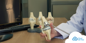 The Future of Knee Treatment: 3D Printing's Gift to Osteoarthritis Patients